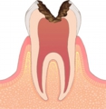 虫歯の原因は？